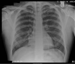 Figure 6. A Normal Chest X-Ray (doctors.net.uk)